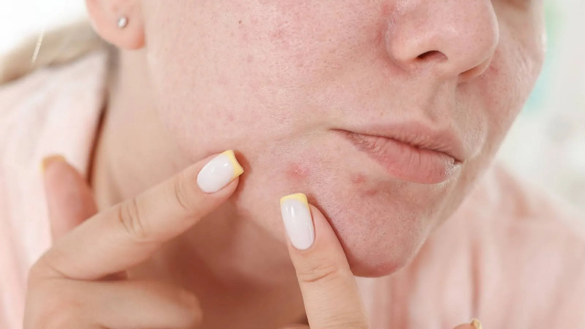 Acne Vs Pimple