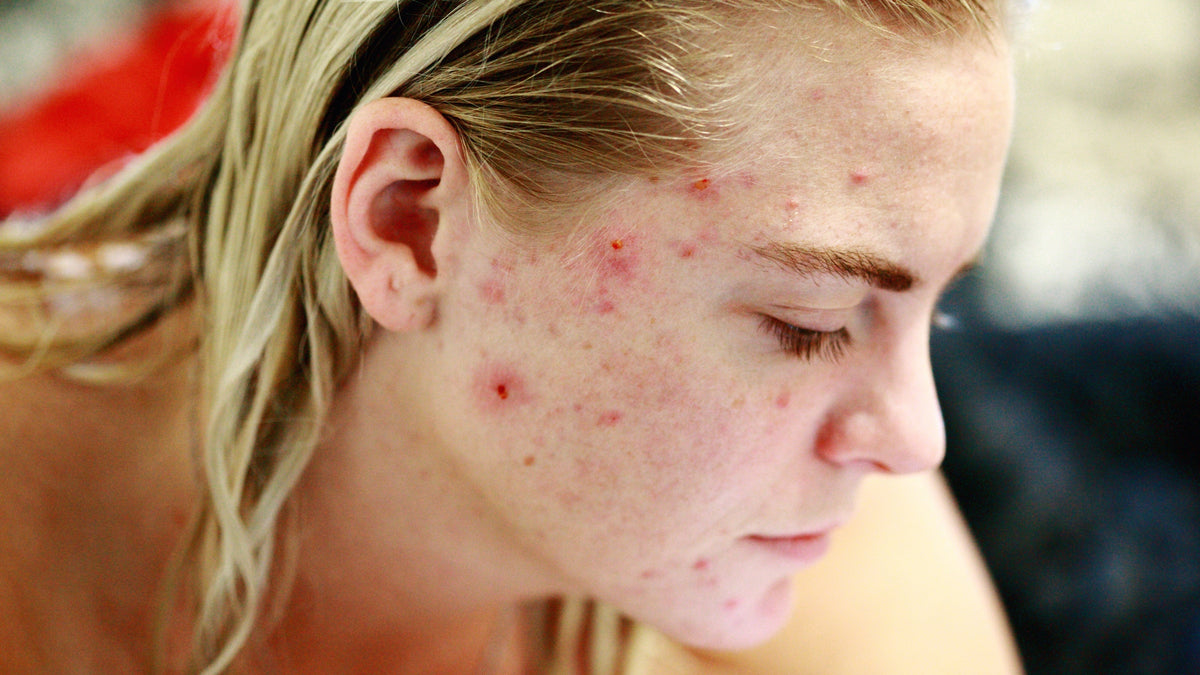 How To Treat Cystic Acne
