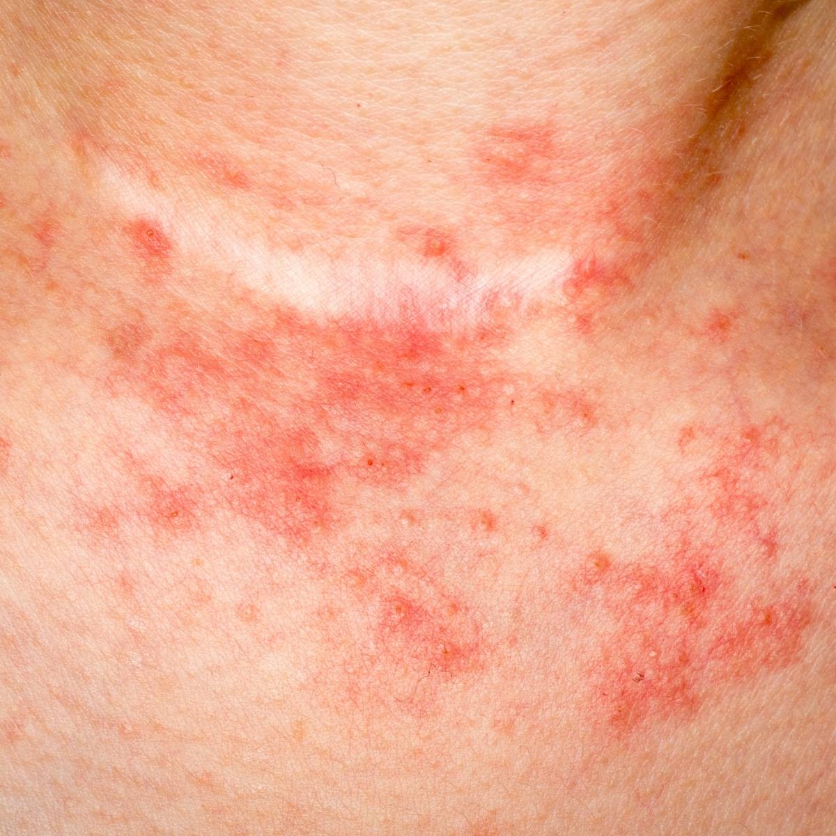 A picture of Eczema
