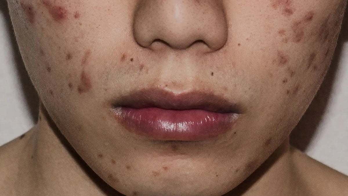How to Prevent Acne Scars