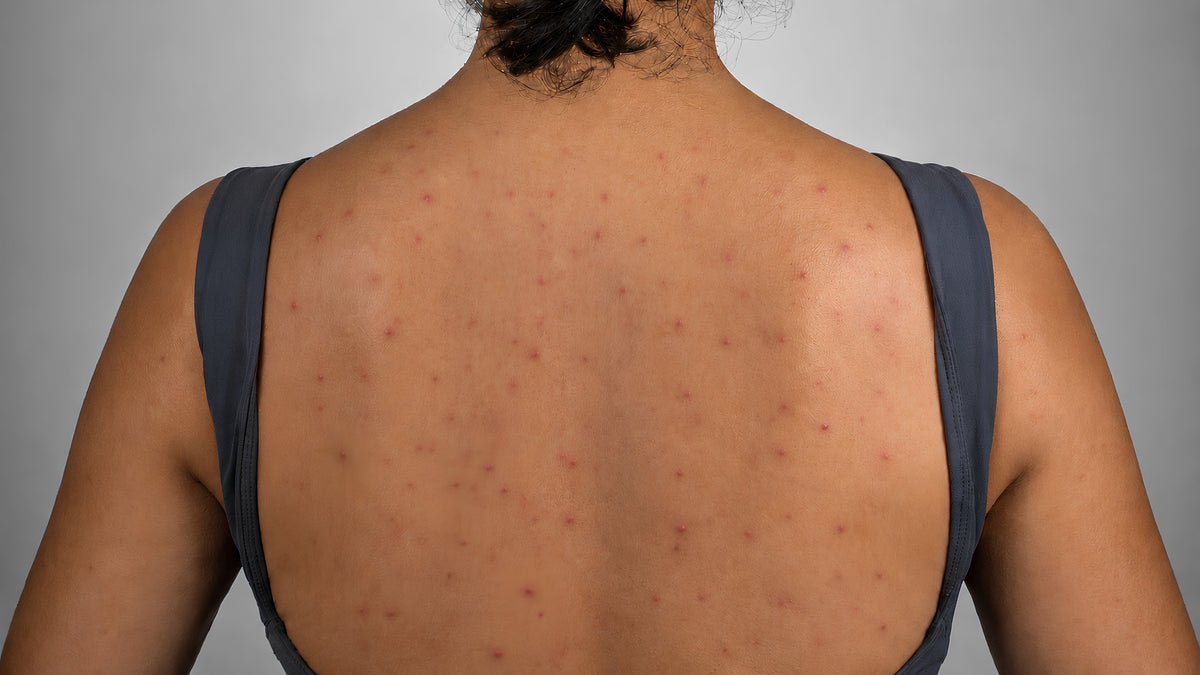 Red Light Therapy for Back Acne