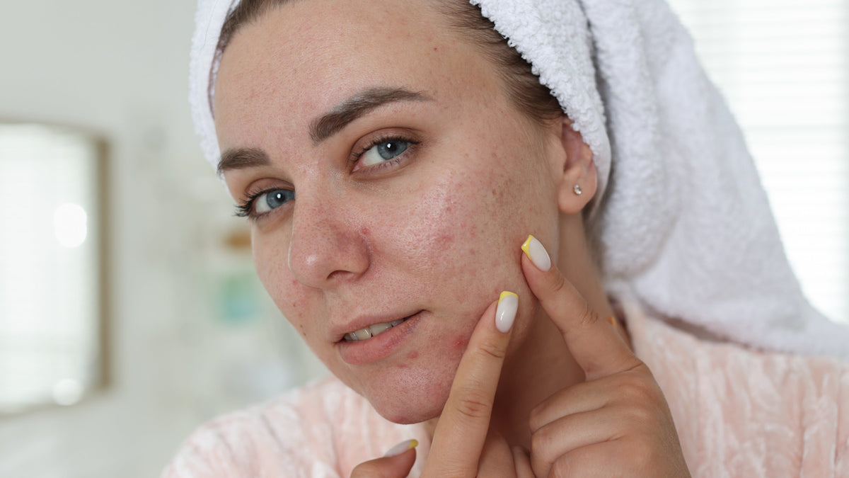 Should you pop a pimple? If Yes, How?