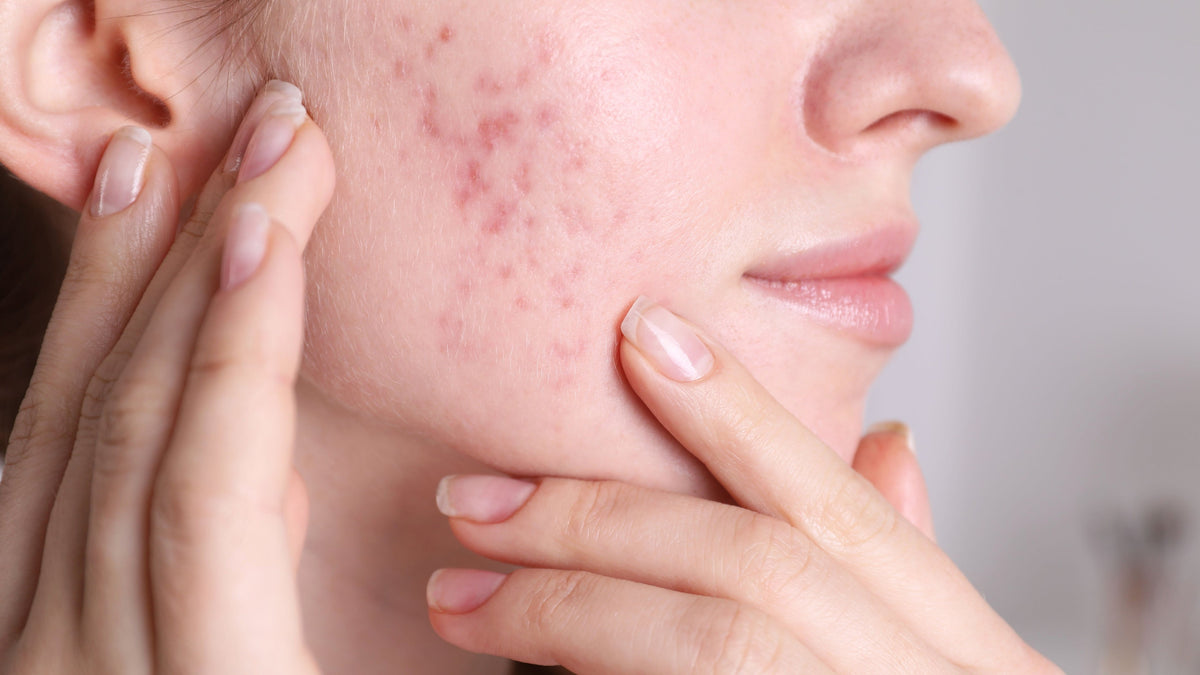 The Types Of Acne: Explained