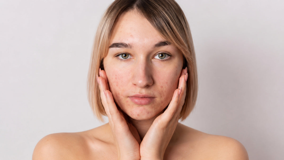 What Is Skin Congestion: Causes and Prevention