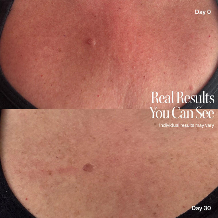 Before and after comparison of chest skin showing reduced redness and texture over 30 days.