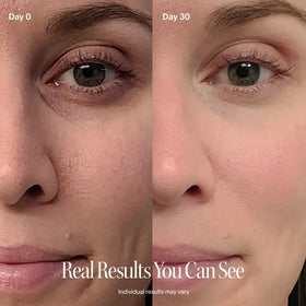 Before and after comparison of a woman's eye area with text 'Real Results You Can See'.