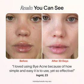 Before and after comparison of a person's face with acne, showing a positive result after using Bye Acne product. before-after || Charcoal