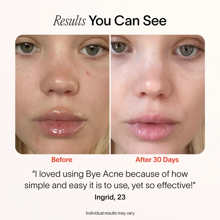 Before and after comparison of a person's face with acne, showing a positive result after using Bye Acne product. before-after || Charcoal