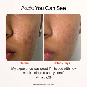 Split image shows a persons cheek before and after treatment. The Before side has visible breakouts, while the After 5 Days side shows clearer skin. Text: I’m happy with my experience using SolaWaves Bye Acne: 3-Minute Pimple Spot Treatment; it significantly cleared up my acne. before-after || Periwinkle