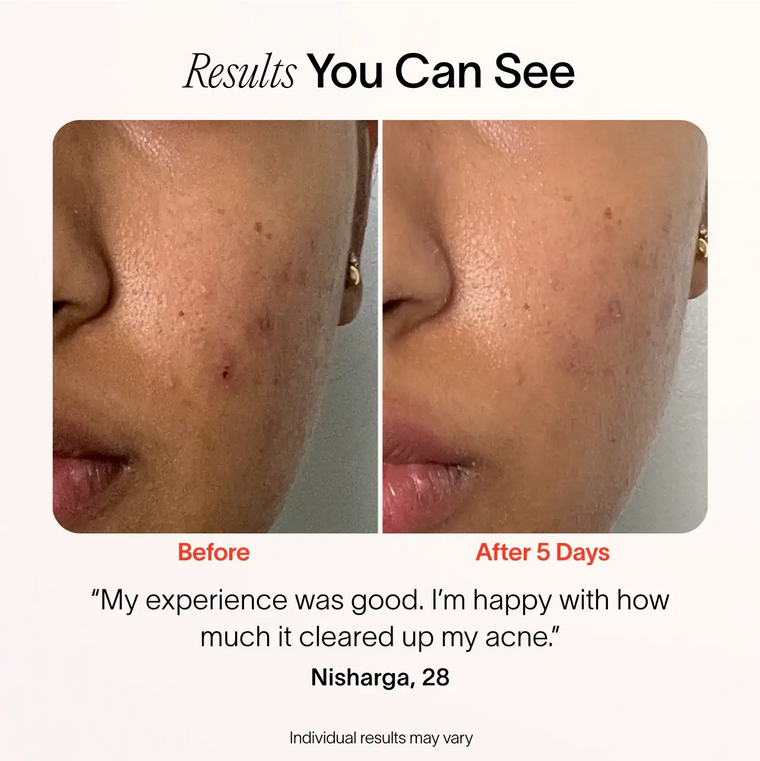 Before and after comparison of skin with acne, showing a positive response to treatment. before-after || Charcoal