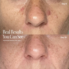 Close-up before and after images of a nose and upper lip show fewer blemishes and smoother skin after 30 days using the Solawave Wrinkle Retreat Pro LED Face Mask with Red, Infrared, Deep Red, and Amber Light Therapy. Individual results may vary.